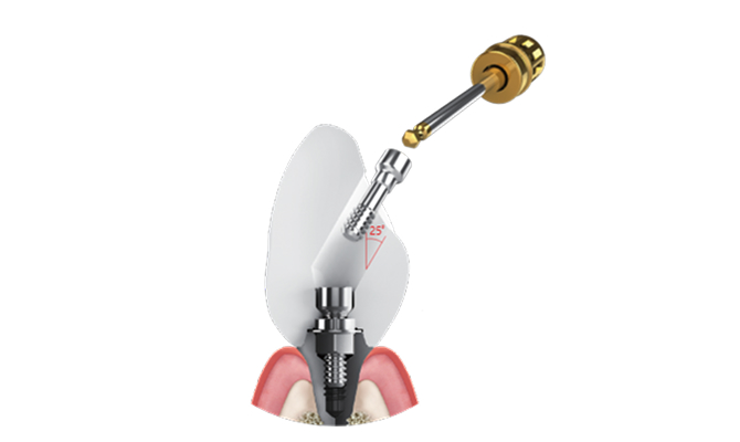하이니스 임플란트 보철 시스템